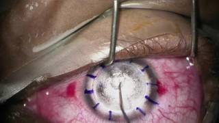 Femtosecond laser deep anterior lamellar keratoplasty [upl. by Florine310]