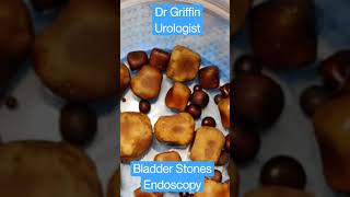 Bladder stone removal  Endoscopic 2500stones taken from a single patient  Dr Griffin Urologist [upl. by Holly539]