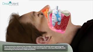 What happens In Obstructive Sleep Apnea OSA with an Innovative Solution [upl. by Ewart]