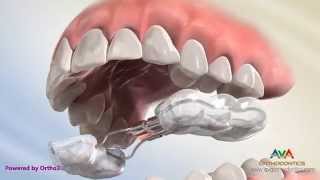 Orthodontic Expander or Spacer  Bonded RPE Appliance [upl. by Verdha880]