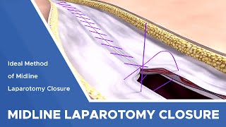 Search for an Ideal Method of Midline Laparotomy Closure Continuous Large Bite Technique [upl. by Ahseekat]