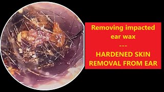 Removing impacted ear wax  HARDENED SKIN REMOVAL FROM EAR EP75 [upl. by Gula]