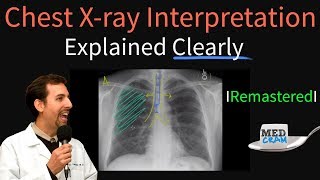 Chest X Ray Interpretation Explained Clearly  How to read a chest Xray [upl. by Anytsyrk]