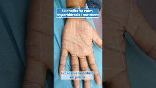 Palm Hyperhidrosis Treatment  5 Benefits of Palm Hyperhidrosis Treatment [upl. by Myers]