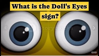 What is the Dolls eyes sign [upl. by Nylirehs]