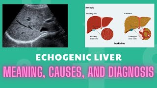 Echogenic Liver Meaning Causes And Diagnosis [upl. by Eremahs431]