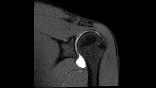 MRI Shoulder Part 1 Anatomy Protocol Checklists [upl. by Avle128]