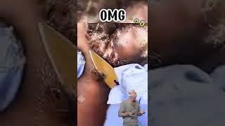 Amazing jiggers removal [upl. by Marcel]