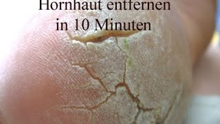 Hornhaut entfernen  Beste und schnellste Methode [upl. by Peonir107]