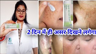 Glycolic Acid 6Cream GA6 Cream honest review GA6 Cream Benefits usesampside effects review hindi [upl. by Wayne643]