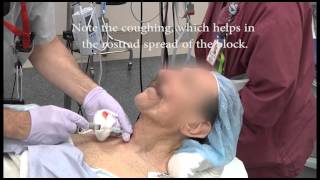 Awake intubation with the Clarus Video System from AOD rerelease [upl. by Bettzel]