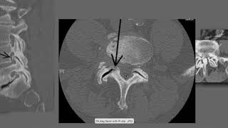 How to Read the CT Scans  How to Read CT Myelograms  How to Read Spine Imaging [upl. by Eladnyl971]