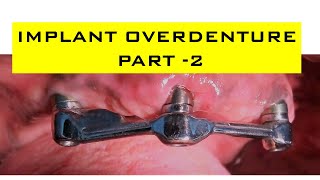 Implant Overdenture Planning  Part 2 Implant Supported Overdenture  Step by Step Planning [upl. by Quill]