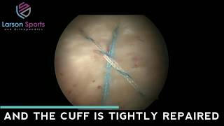 Arthroscopic Rotator Cuff Repair [upl. by Omsare]