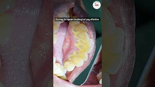 Is dental scaling harmful dentalscaling toothcleaning [upl. by Laohcin663]