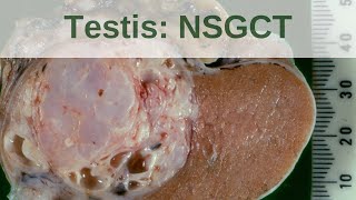 Testicular germ cell tumours  Non seminomatous germ cell tumours  Pathology mini tutorial [upl. by Antonius]