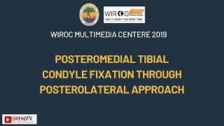 Posteromedial Tibial Condyle Fixation through Posterolateral Approach [upl. by Nitsoj807]