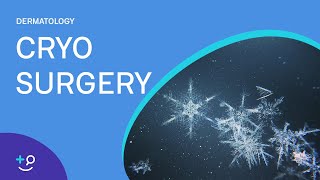 Cryo Surgery Procedure Freezing [upl. by Blondy]