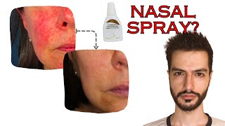 Rosacea Redness treatment with a Nasal Spray  Mo React [upl. by Lehpar688]