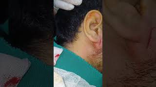 Incision and drainge of absces inferior to rt ear lobule entdoctor [upl. by Yenahc]