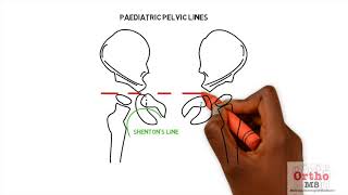 Radiographic features  Paediatric pelvic lines [upl. by Goles]