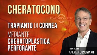 Cheratocono e trapianto di cornea cheratoplastica perforante [upl. by Eerdna]