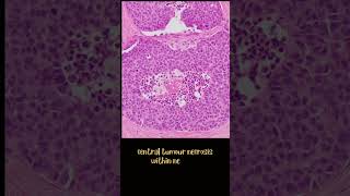 Medullary thyroid carcinoma [upl. by Ewart948]