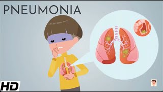 Pneumonia Everything You Need To Know [upl. by Nibram]