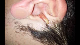 Manifesting Ear Cyst [upl. by Surtemed129]