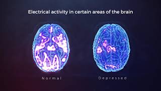 Breakthrough Depression Treatment TMS Therapy At Florida TMS Clinic In The Tampa Bay Area [upl. by Pendergast]