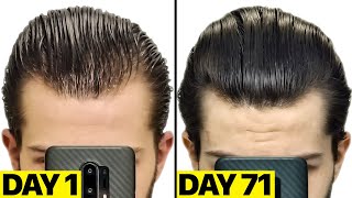 My INSANE Finasteride amp Minoxidil 25 Months Results [upl. by Ahsiuqel]