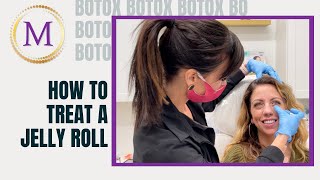 How to Treat A Jelly Roll using Botox [upl. by Bab163]