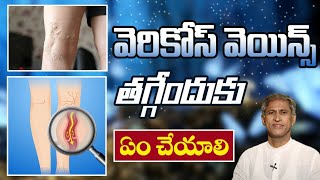 VaricoseVeins Treatment  Health Tips in Telugu  ManthenaSatyanarayanaRajuVideos [upl. by Olotrab]