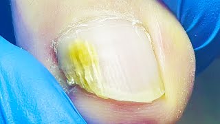 Early stage of onychomycosis bacteria invaded the insideProfessional pedicureonychomycosis [upl. by Berkley653]