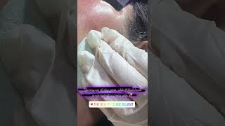 Hydrafacial cleaning out blackampwhite heads skincare beautyclinic beauty hydrafacial [upl. by Yeldah]