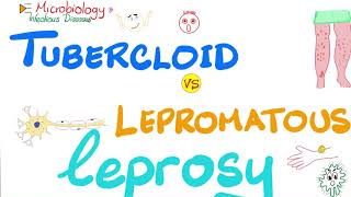 Leprosy  Tuberculoid Leprosy vs Lepromatous Leprosy  Comparisons Playlist [upl. by Reilamag]