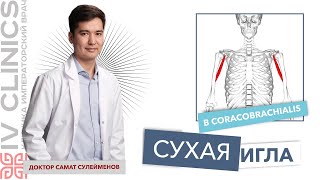 Сухая игла Coracobrachialis КЛЮВОВИДНОПЛЕЧЕВАЯ МЫШЦА Безопасная постановка иглы [upl. by Amhser98]