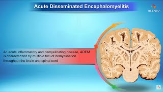 Acute disseminated encephalomyelitis  Neurology [upl. by Ardeth]