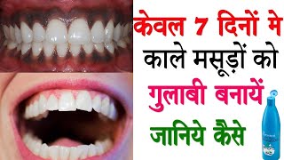 काले मसूड़ो को गुलाबी करने का कारगर नुस्खा How To Have Pink Gums Quickly At Home [upl. by Tristram]