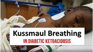 Kussmaul Breathing in Diabetic Ketoacidosis [upl. by Eenej453]