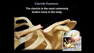 Clavicle Fractures  Everything You Need To Know  Dr Nabil Ebraheim [upl. by Anaeirb]