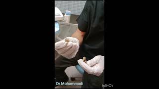 The mandibular first molar that is covered without trimming and RCT is a completely wrong treatment [upl. by Joacima]