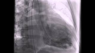 Ventriculogram Myopathy Secondary to Chronic Alcohol Abuse [upl. by Schulein257]