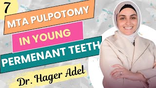 MTA pulpotomy in young permanent teeth  Dr Hager Adel [upl. by Karena277]