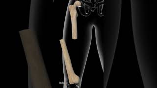 4 Most Painful Femur Shaft Fractures [upl. by Dragelin179]