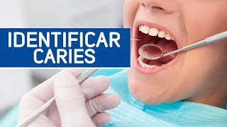 ¿Cómo puedo identificar las caries dentales [upl. by Cogswell]