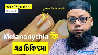 melanonychia নখের রং পরিবর্তন হয়ে যাওয়াকারন চিকিৎসা উদ্বিগ্নতার বিষয় [upl. by Eseryt]