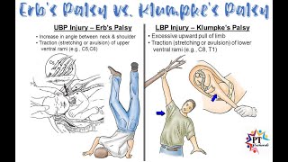 Erb Duchennes palsy and Klumpkes palsy differences Anatomically and Clinically [upl. by Snebur]