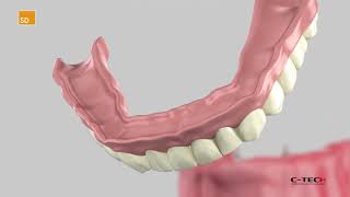 SD Small Diameter  Surgical Protocol [upl. by Arlo129]