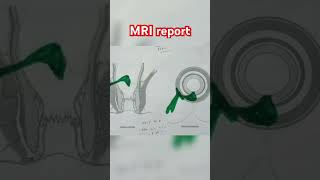 MRI report fistula surgery complex fistula ytshorts fistulatreatment tula [upl. by Olney]